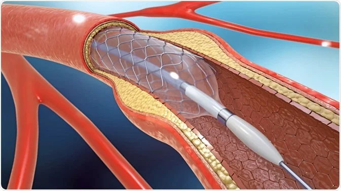 Drug Eluting Stents