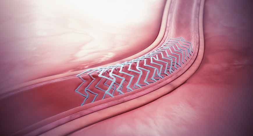Bioresorbable Stent