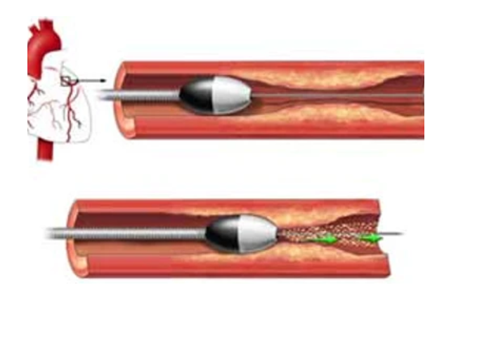 Rotational Atherectomy