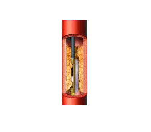 Directional Atherectomy