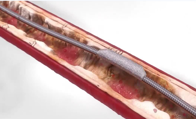 Orbital Atherectomy