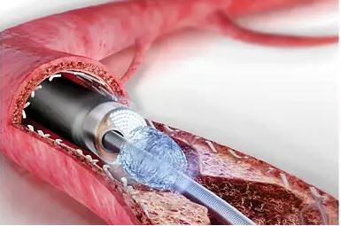 Laser Atherectomy