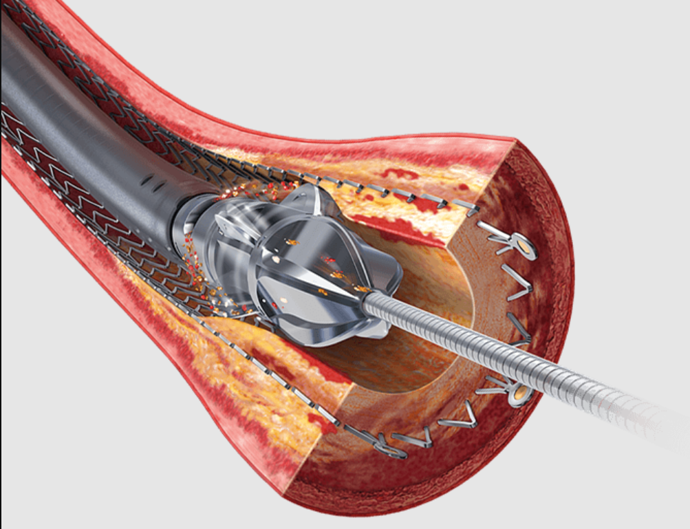 Jetstream Atherectomy