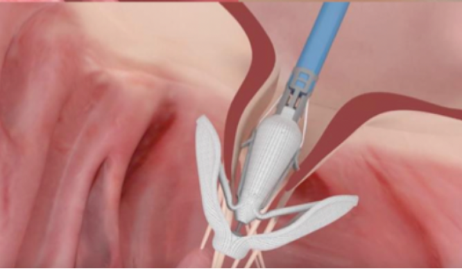 Percutaneous Repair Devices