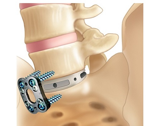 Spinal Fusion Devices