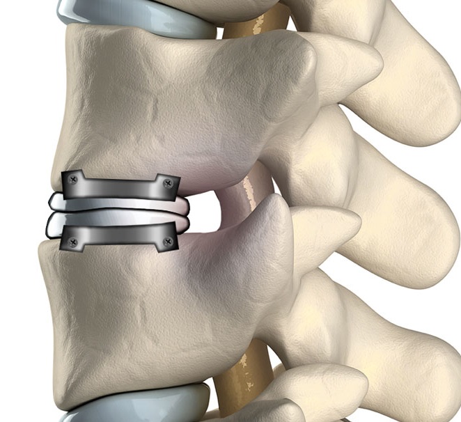 Artificial Discs