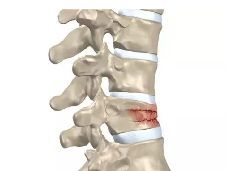 Vertebral Compression Fracture Treatment Devices