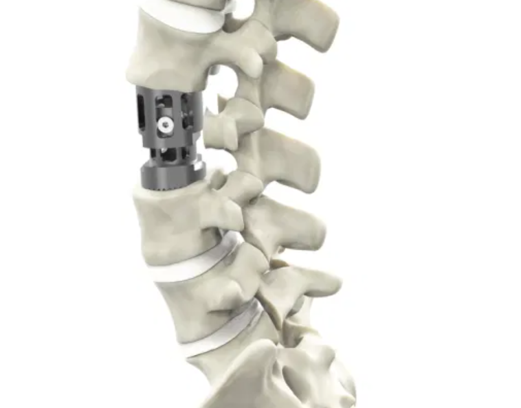 Expandable Implants