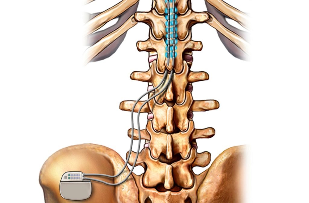 Spinal Cord Stimulators