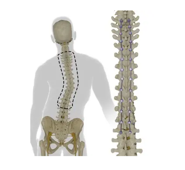 Scoliosis Correction Systems