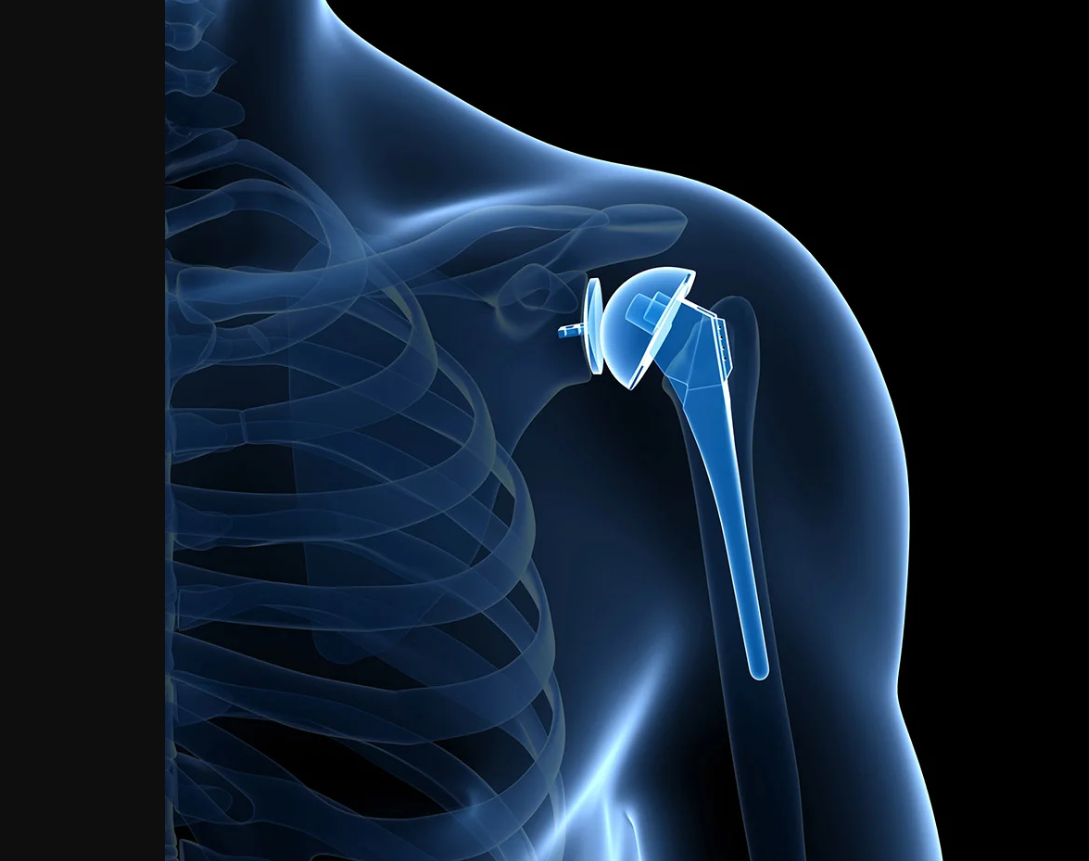 Arthroplasty