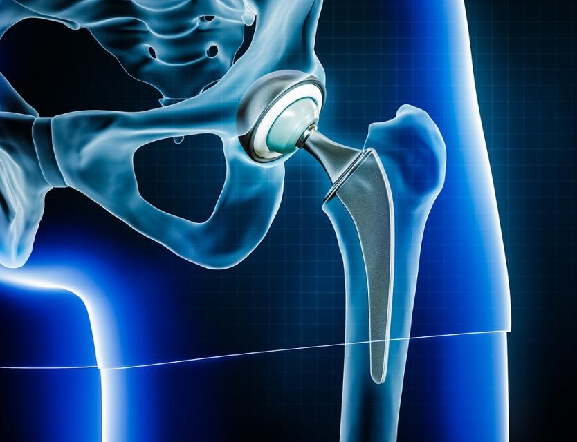 Joint Replacement